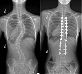 Before and after surgery for scoliosis
